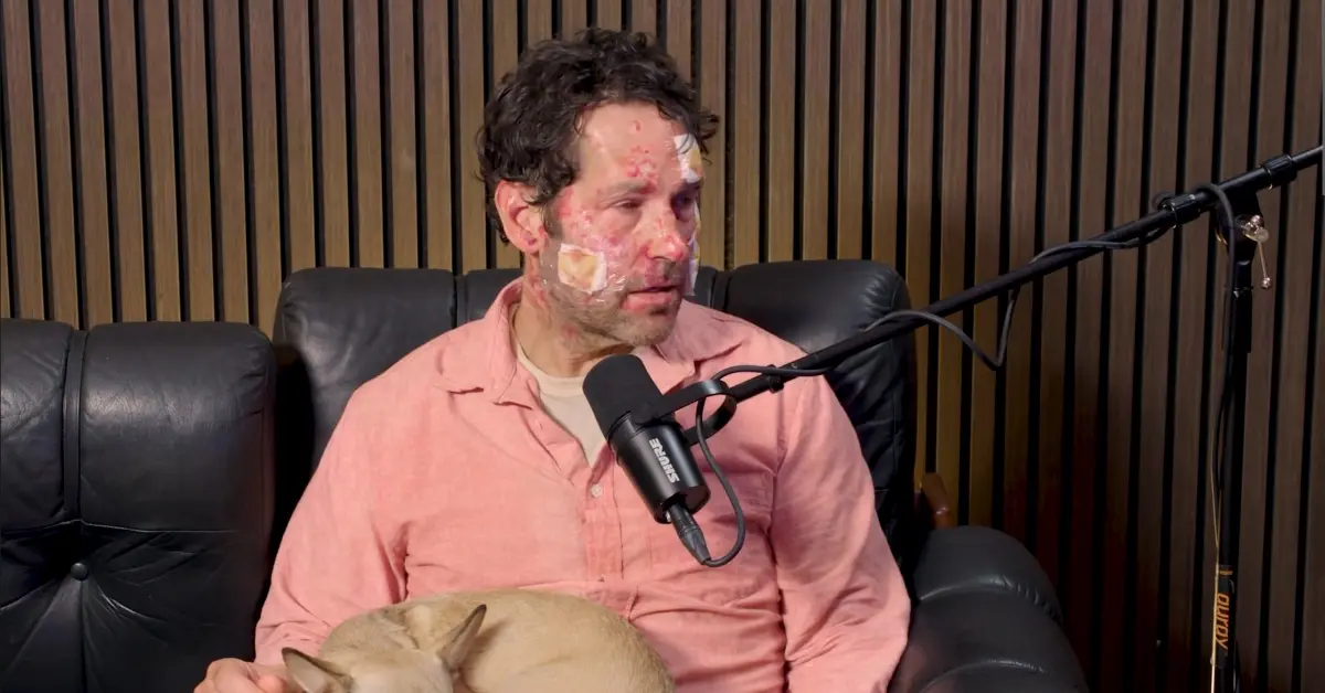 Paul Rudd Burn Injury Separating Fact from Fiction and Understanding