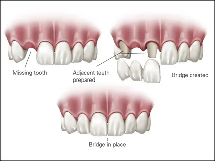 Dental Bridges Near Me Your Complete 2026 Guide to Replacing Missing Teeth