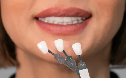 Veneers Near Me Your Complete 2026 Guide to Dental Veneers