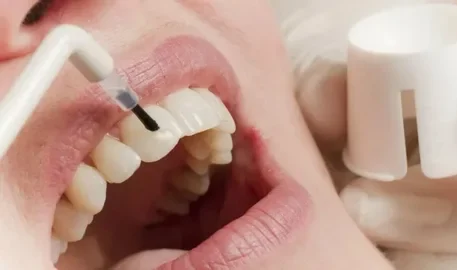 Fluoride Treatment Near Me Your Complete 2026 Guide to Stronger, Healthier Teeth